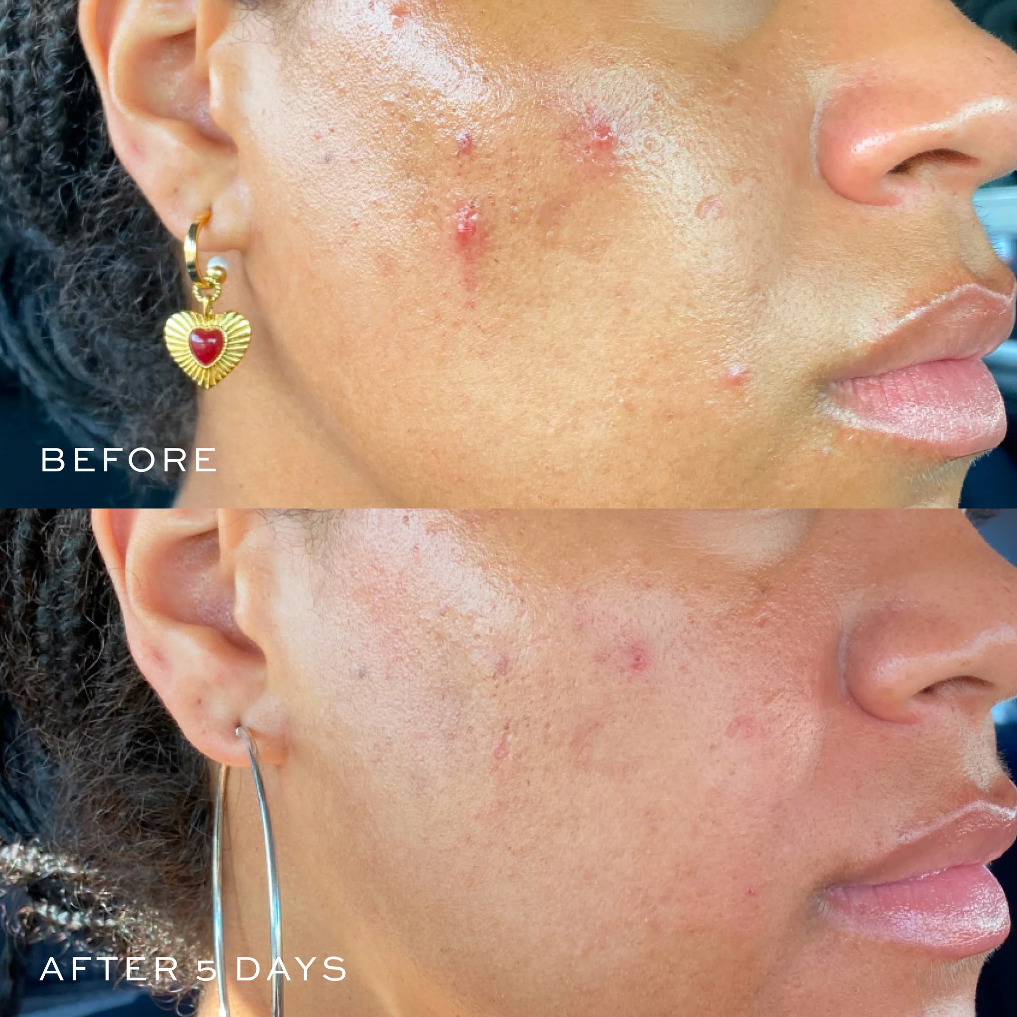 Acne Spot Treatment - Image 5